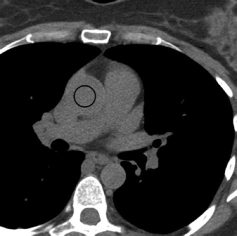 Heart And Pericardium Radiology Key