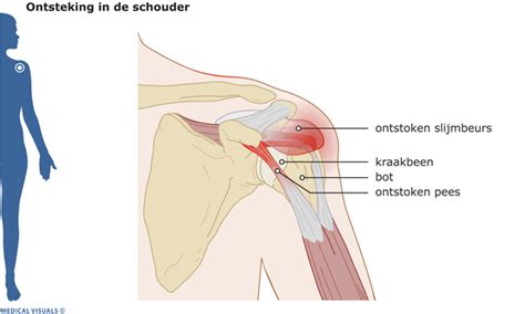 Schouderklachten Struijkfysio Amersfoort Nl