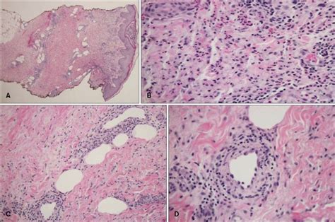 A Inflammatory Infiltrate Around The Vessels Hande ×20 B Dermal Download Scientific