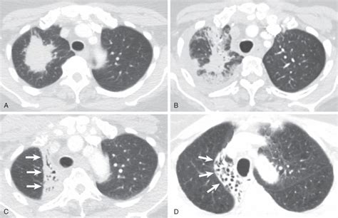 Atelectasis Radiology Key