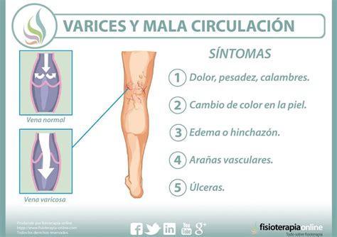 Varices El Castigo De La Circulación Fisioonline