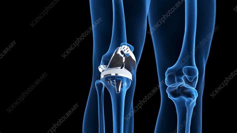 Knee Replacement Illustration Stock Image F038 4436 Science