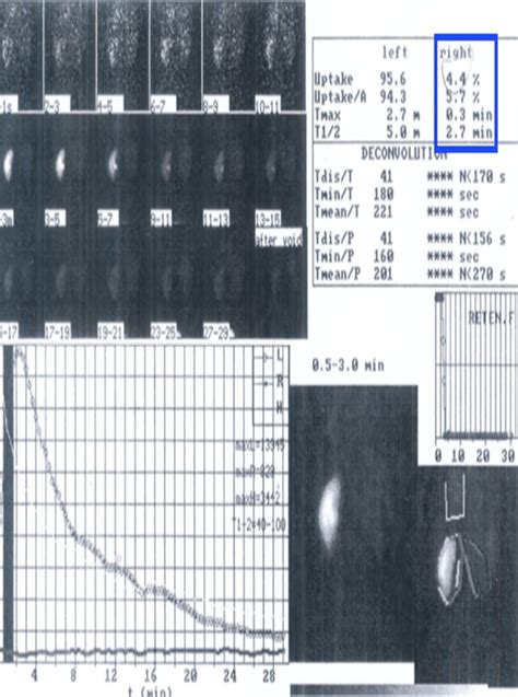 MAG3 scan detected 4.4% activity on the side where no renal tissue was ...