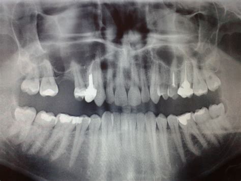 Stożkowa tomografia komputerowa CBCT w diagnostyce zmiany zapalnej