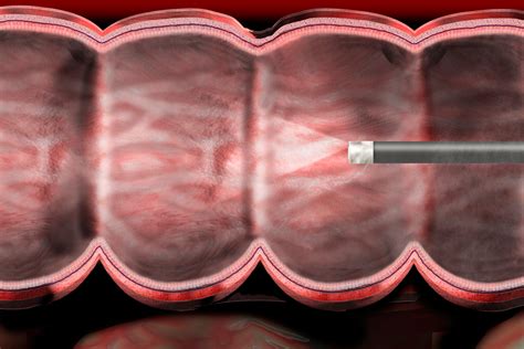 7 Things You've Always Wondered About a Colonoscopy Procedure | SELF