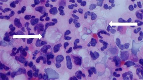 Clinical and Laboratory Diagnosis for Naegleria fowleri Infection | Naegleria fowleri Infection ...