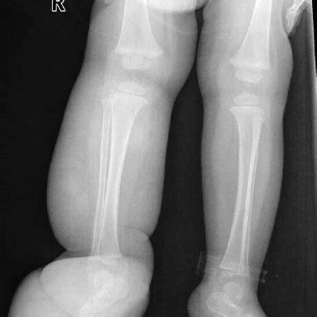 Frontal Radiograph Of The Lower Limbs There Is Diffuse Soft Tissue