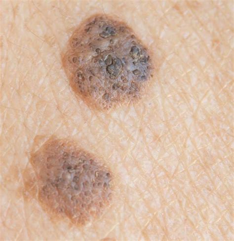 Seborrheic Keratosis Vs Melanoma Whats The Difference