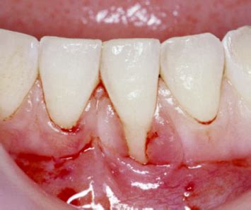 4 The Role Of Mucogingival Therapy Pocket Dentistry