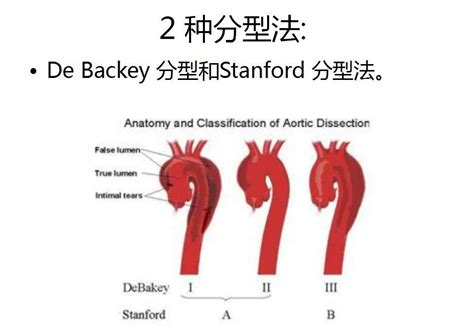 主动脉夹层的影像诊断这样鉴别更简单 好医术早读文章 好医术 赋能医生守护生命