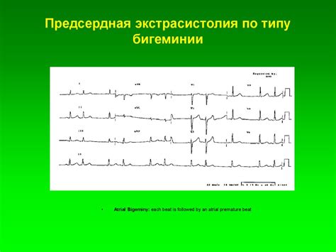 Электрокардиография. Методика записи ЭКГ - online presentation