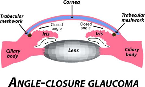 Glaucoma Treatment Kennedy Vision Health Center