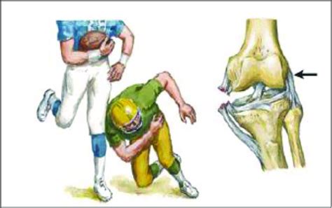 The MCL Sprain Mechanism. | Download Scientific Diagram