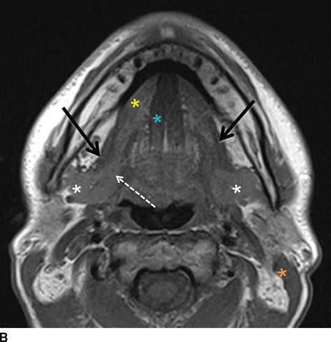 The Glands Salivary Thyroid And Parathyroid Imaging Radiology Key