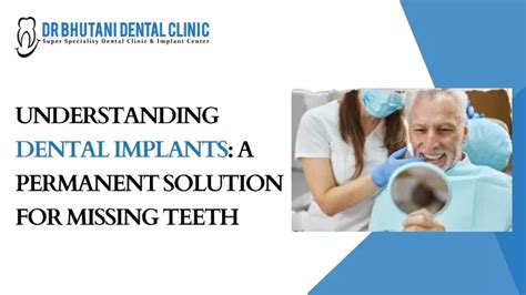 Ppt Understanding Dental Implants A Permanent Solution For Missing