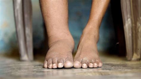 5 Fakta Tentang Filariasis Penyakit Yang Ubah Kaki Seukuran Gajah