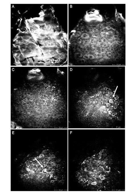 3d Imaging Of A Nevus At The Back Of A Female Patient A Stratum