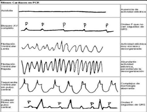 Paro Cardiorrespiratorio Rcp Ritmos Desfibrilables Y No