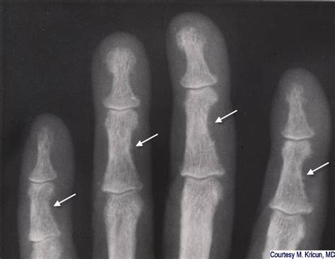 LearningRadiology - hyperparathyroidism, primary, secondary, tertiary ...