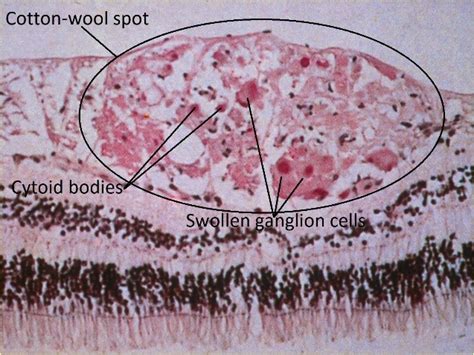 Moran Core Retina Rpe Histopathology