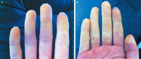 Understanding Raynaud’s Disease Things Health