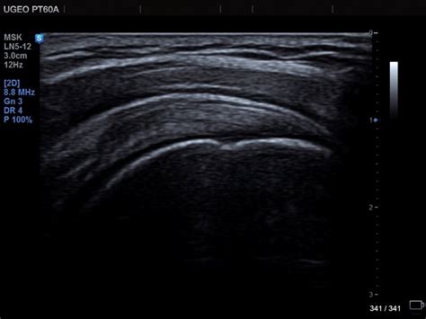 Ultrasound images - Supraspinatus tendon, MultiVision, echogramm №683