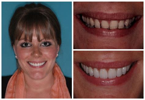 Porcelain Veneers London £54 Per Month Aqua Dental Clinic London