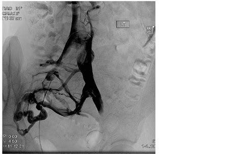 Towards A Classification Of Left Common Iliac Vein Compression Based On