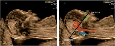 Spina Bifida Ultrasound 13 Weeks