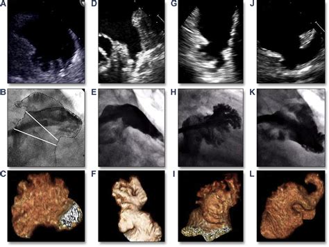 The Left Atrial Appendage Anatomy Function And Noninvasive