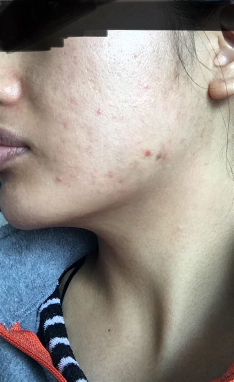 [acne] Tried Everything Nothing Seems To Work R Skincareaddiction