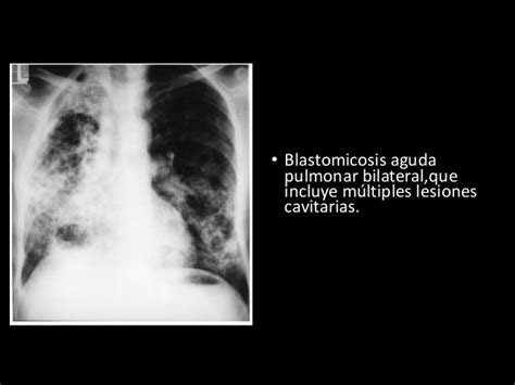 Blastomicosis Aguda Pulmonar Bilateral Que Incluye M Ltiples Lesiones