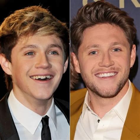 Niall Horan's Smile Makeover Journey