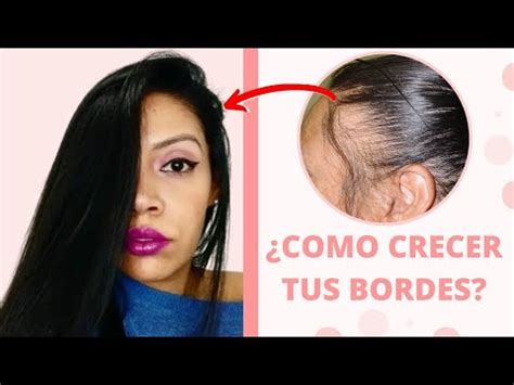 C Mo Hacer Crecer El Cabello De Las Entradas Recupera El Pelo De Las