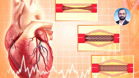 After Angioplasty Maximizing Life Expectancy With Expert