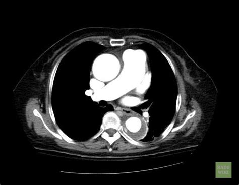 Aortic intramural hematoma - wikidoc