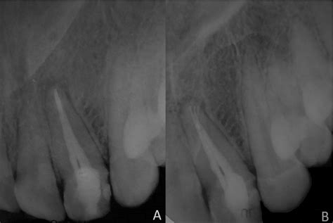 Figure 2 From Case Diagnosis And Treatment Of A Maxillary Lateral Incisor With Two Root Canals