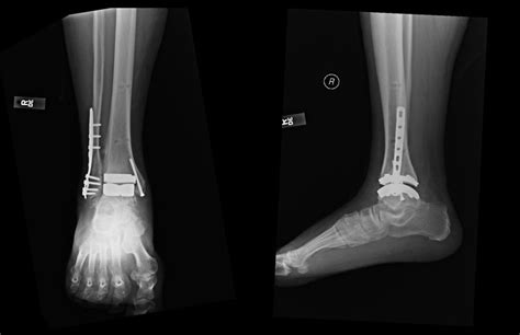 Leading Edge Developments For Total Ankle Arthroplasty Broadcastmed