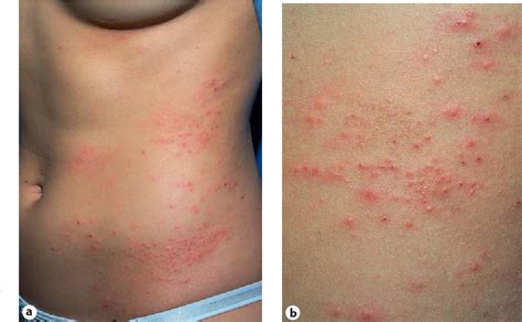 Maculopapular Rash Causes Treatment And Pictures Artofit