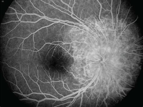 At Age Fluorescein Angiogram Of The Right Eye Shows Extensive