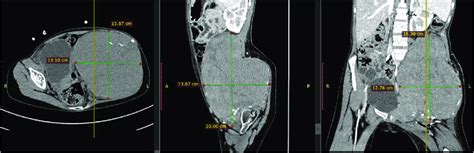 Ct Scan Of A Patient Showing Ill Defined Heterogeneously Enhancing Soft