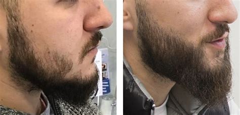 Patchy Facial Hair Fix