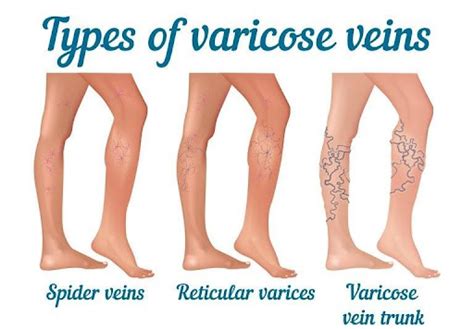 Varicose Veins Maple Clinic