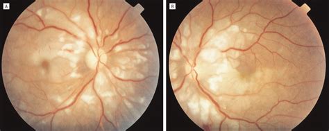 Purtscher Retinopathy As The Initial Sign Of Thrombotic