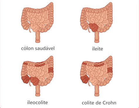 Doença de Crohn o que é causas sintomas Biologia Net