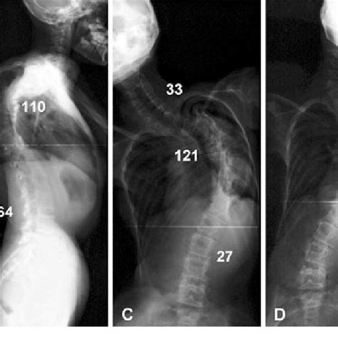 Preoperative Plain Radiographs A Plain Radiograph Showing Severe