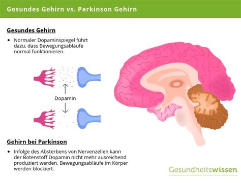 Parkinson Ursachen Symptome Diagnose Behandlung