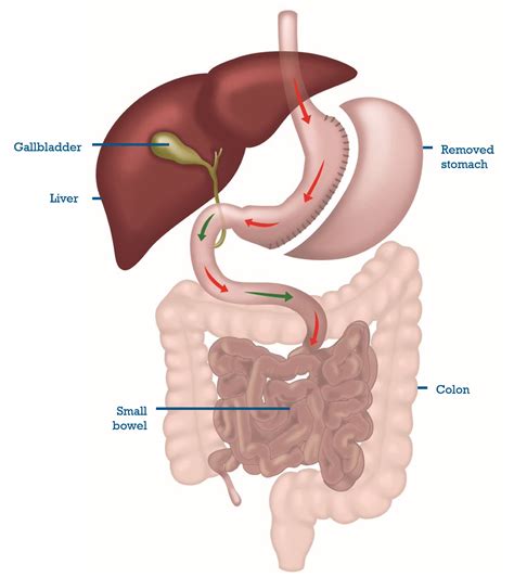 Laparoscopic Sleeve Gastrectomy