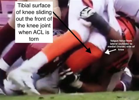 Joe Burrow: ACL, MCL tear – Dr. John M. Kunkel