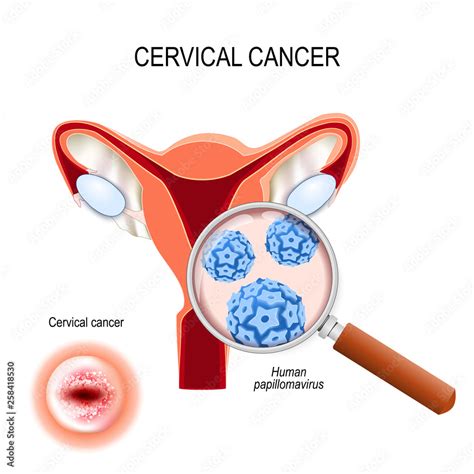 Cervical Cancer Close Up Of Human Papillomavirus Infection Hpv Cut